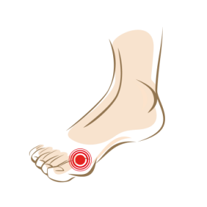 Hallux-valgus-loop-zonder-pijn